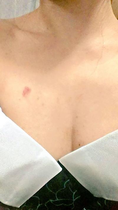 キスマークにエロを感じるあなたは立派なフェチ道を歩んでますのサムネイル画像